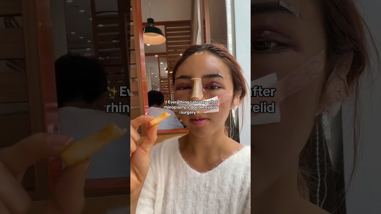 Day After Surgery Going Strong 🫶🏻 #plasticsurgerykorea #plasticsurgeryinkorea #recovery #rhinoplasty