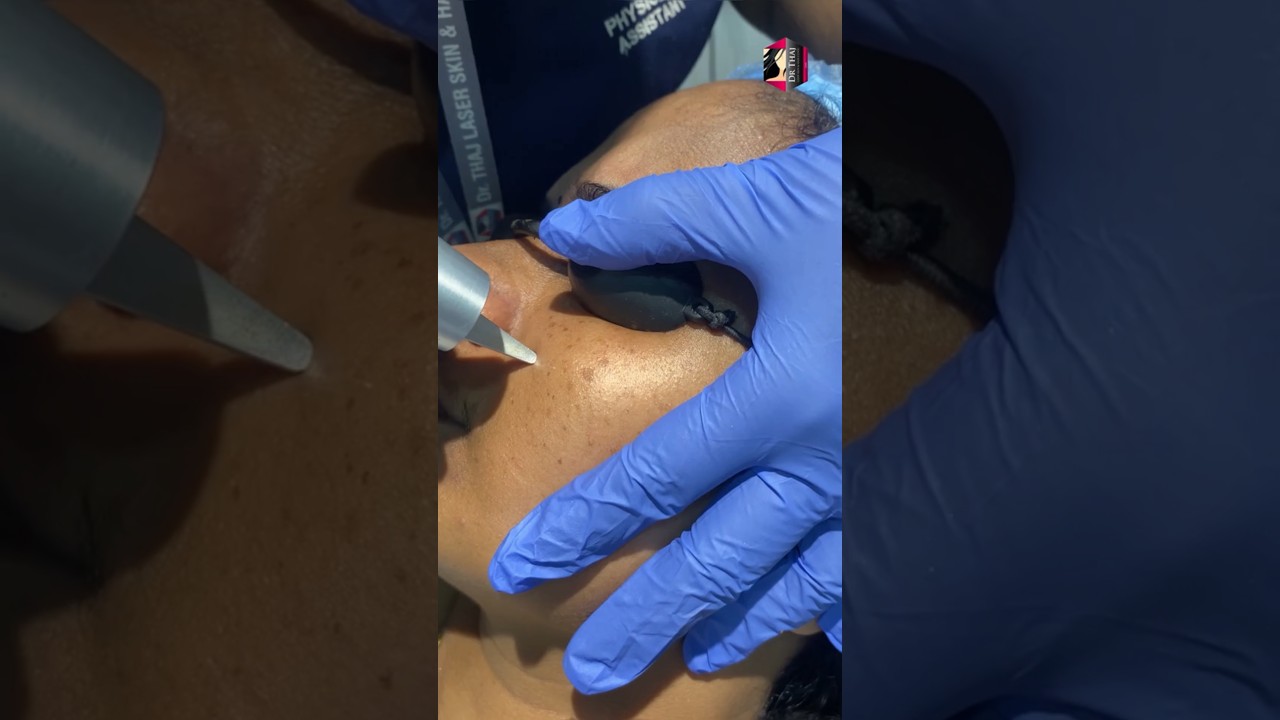 Freckles treatment with Q switched ND Yag Laser done at Dr Thaj clinic✨#freckles #skincare #shorts