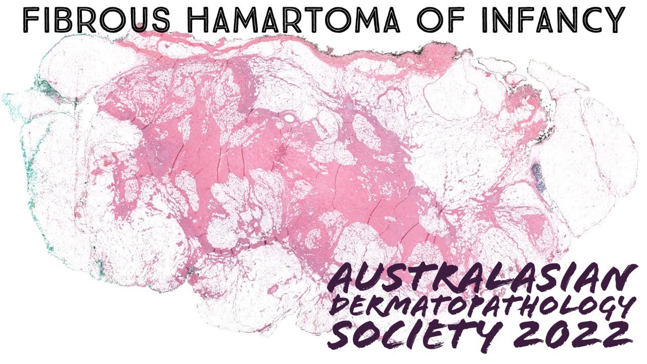 Fibrous hamartoma of infancy explained in 5 minutes (pathology dermpath dermatology)