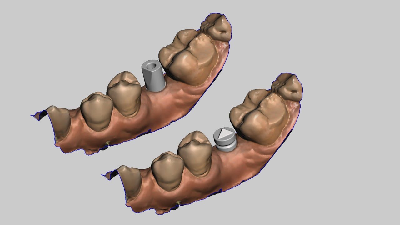 Cerec - Converting Neodent Scanbody to Sirona Scanbody