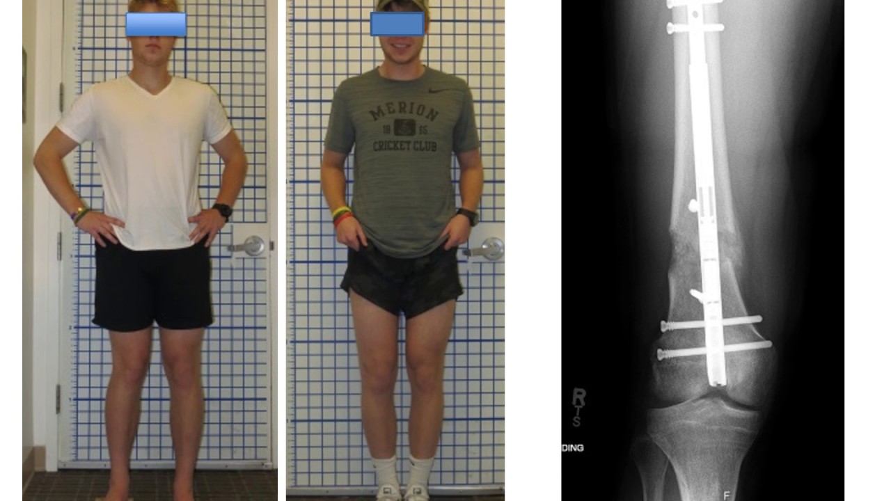 Dr. Rozbruch Discusses Knock-Knee Treatment