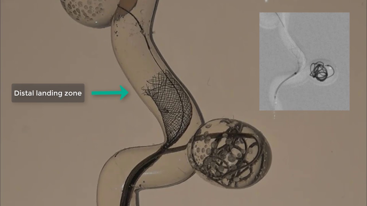 SILK FLOW DIVERTER DEPLOYMENT