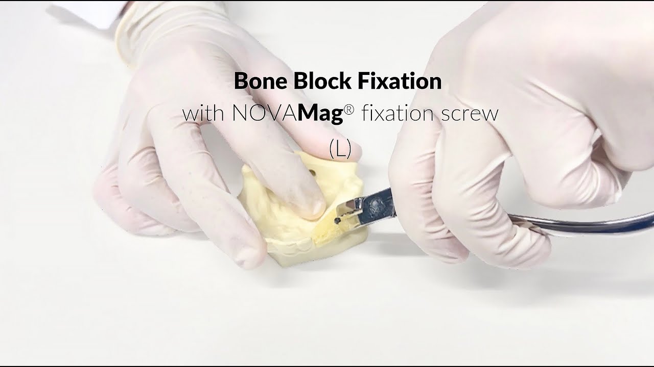 Bone block augmentation with NOVAMag® fixation screw (L)