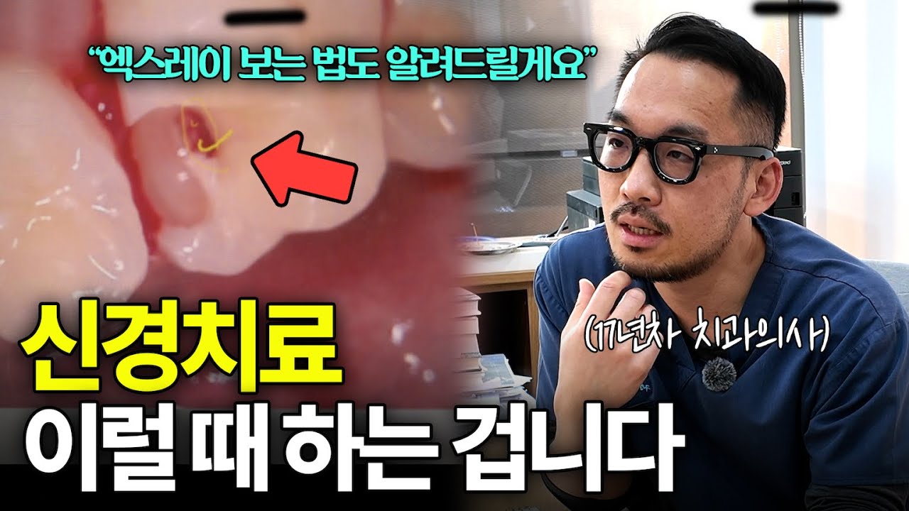 엑스레이보고 신경치료 필요한 치아 구별하는 법 l 치과 과잉진료 피하는 법