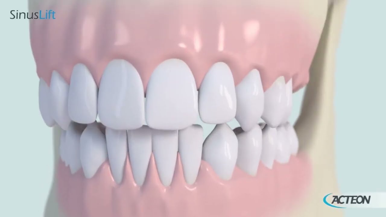 TUTORIAL Sinus Lift 3D 2023 - Surgery tips - Equipment - Acteon Group