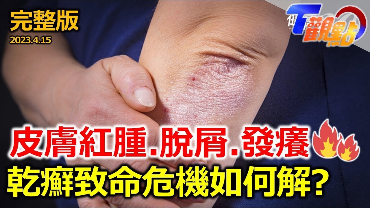皮膚隱藏炸彈！超危險GPP如何脫「癬」？ 破解乾癬「六大迷思」 亂吃補藥反陷「癬」境 薑母鴨.羊肉爐引爆乾癬地雷？健保卡關用藥受阻？病團呼籲體恤病友 ! T觀點 20230415 (完整版)