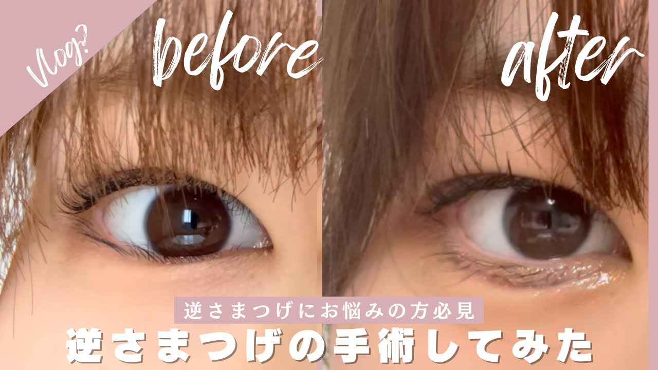 【逆さまつげ】下まつ毛の逆さまつげに悩んでたから手術してきたわ