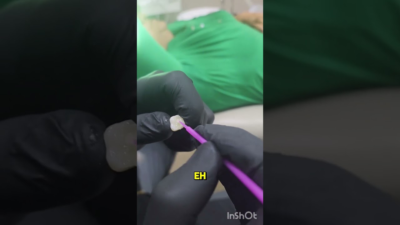 PROTOCOLO DE CEMENTACION CORONAS CEMENTO ATORNILLADAS SOBRE IMPLANTES