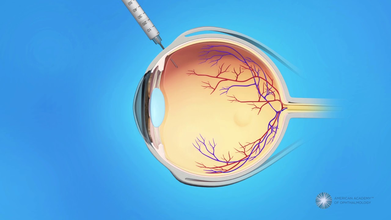 How are eye injections done?
