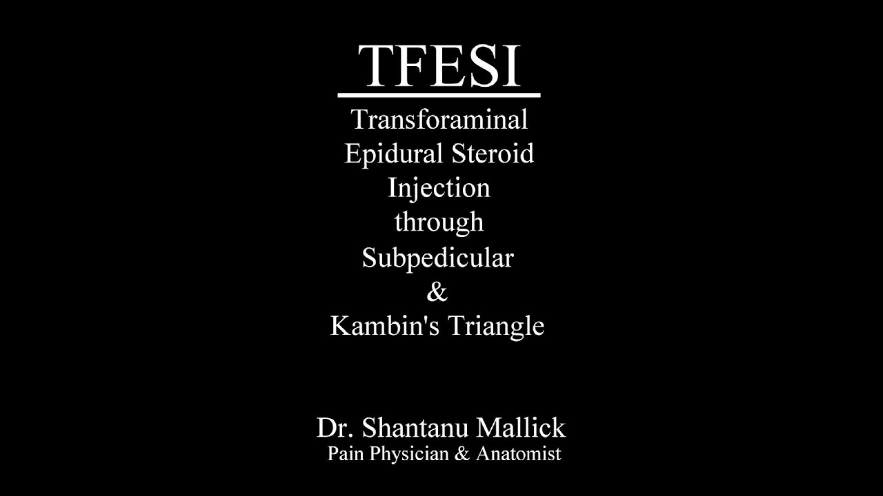 TFESI through Sub-pedicular & Kambin's triangle approach