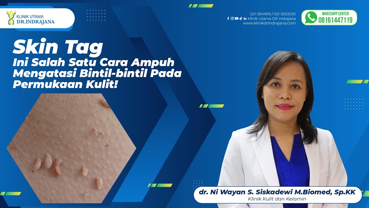 INI SALAH SATU CARA AMPUH MENGATASI BINTIL-BINTIL SKIN TAG PADA PERMUKAAN KULIT!