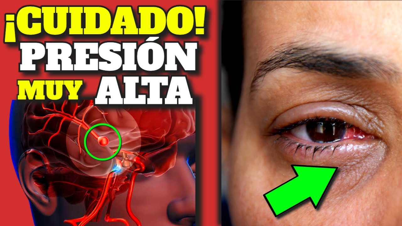 ¡PELIGRO! SINTOMAS de ALARMA de HIPERTENSIÓN ARTERIAL| COMO BAJAR LA PRESION MUY ALTA