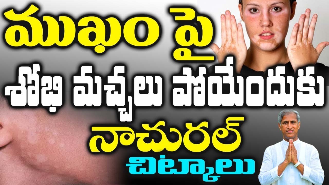 ముఖం పై శోభి మచ్చలు పోయేందుకు నాచురల్ చిట్కాలు | Manthena Satyanarayana Raju videos| health mantra |