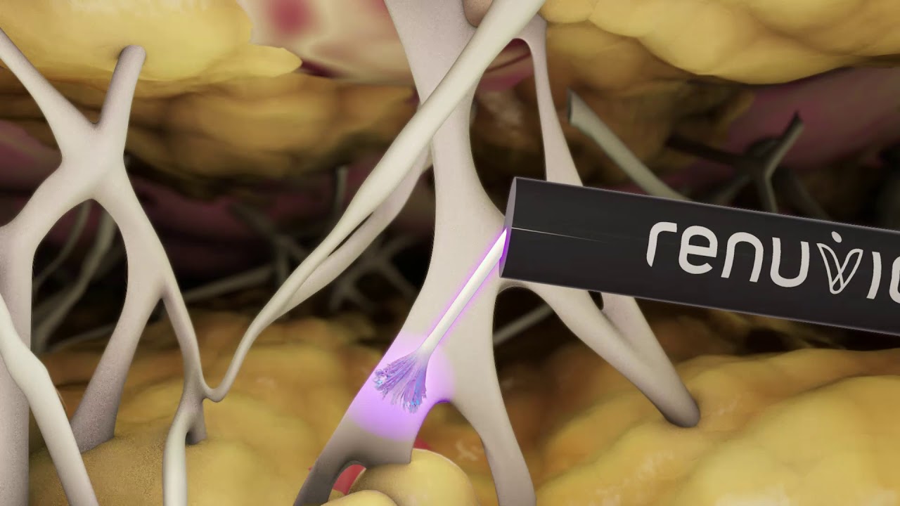 How Renuvion works????