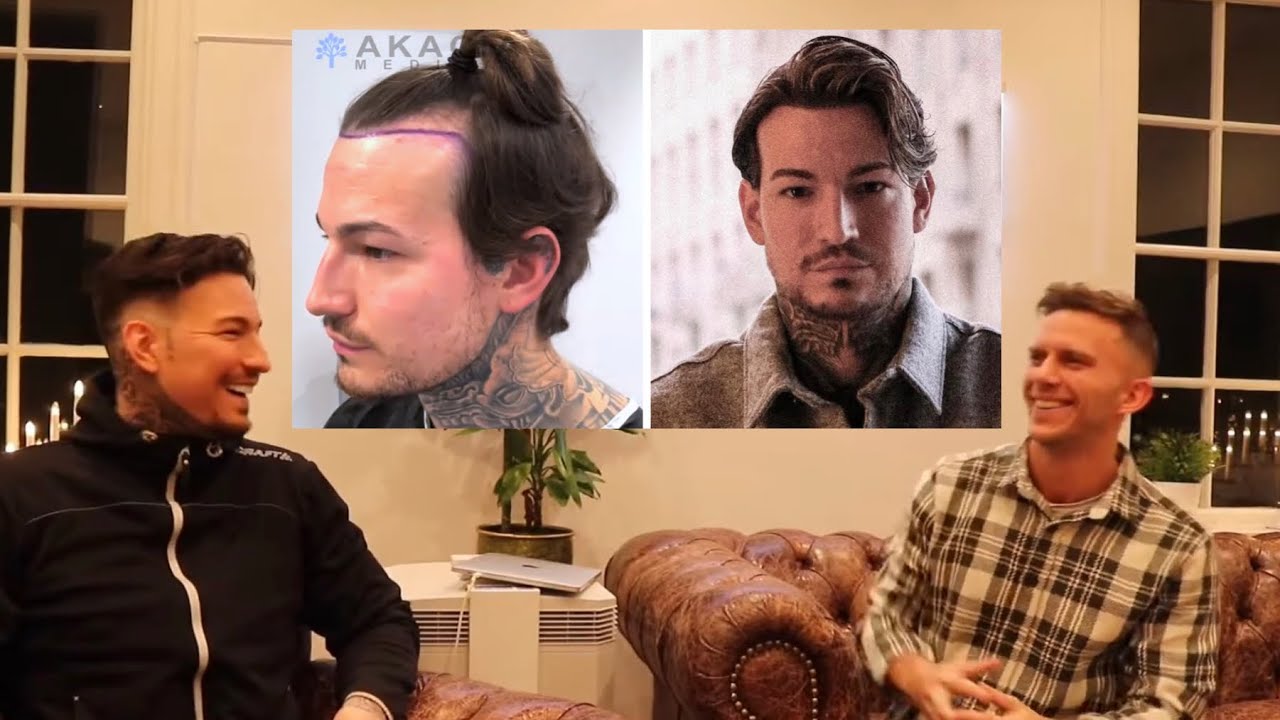 TV-profilen Marcelo 1 år efter sin hårtransplantation (1500 hårsäckar)