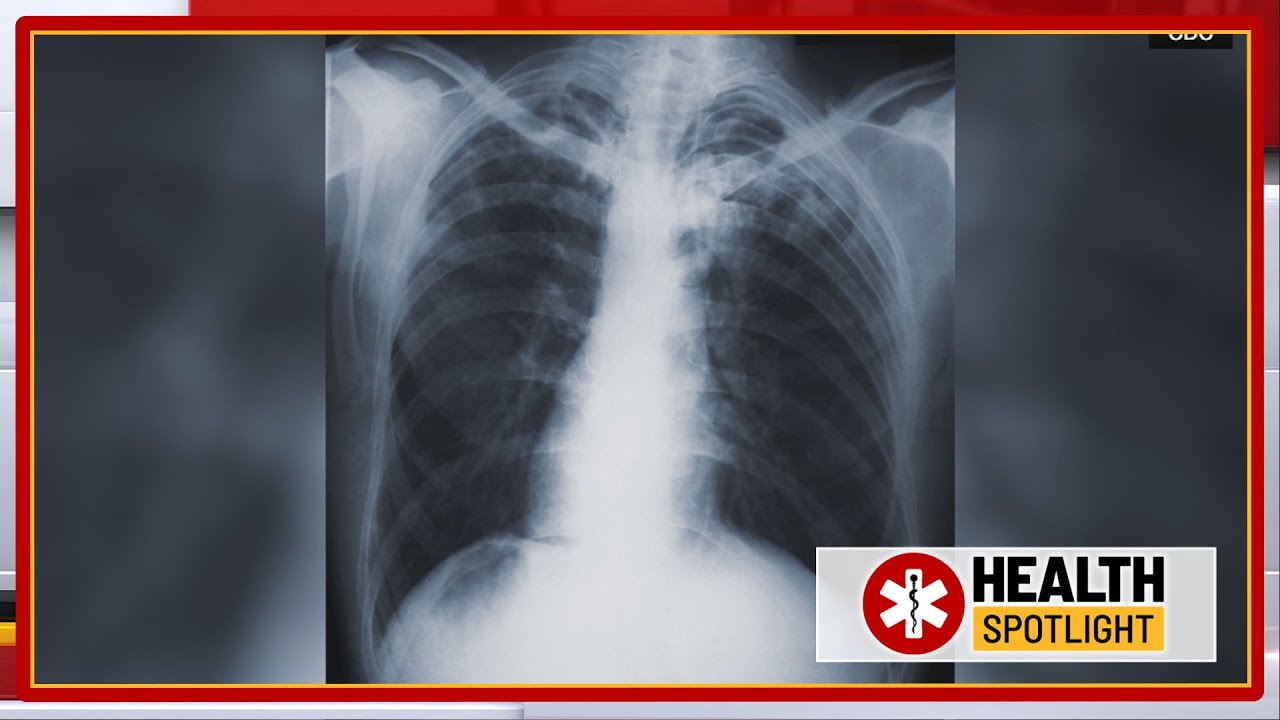 Morning Checkup | Tuberculosis outbreak hits Kansas City