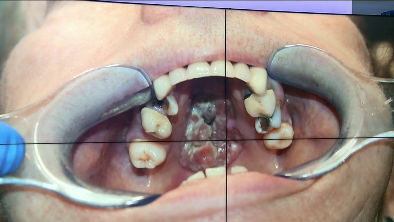 Warning signs of oral cancer
