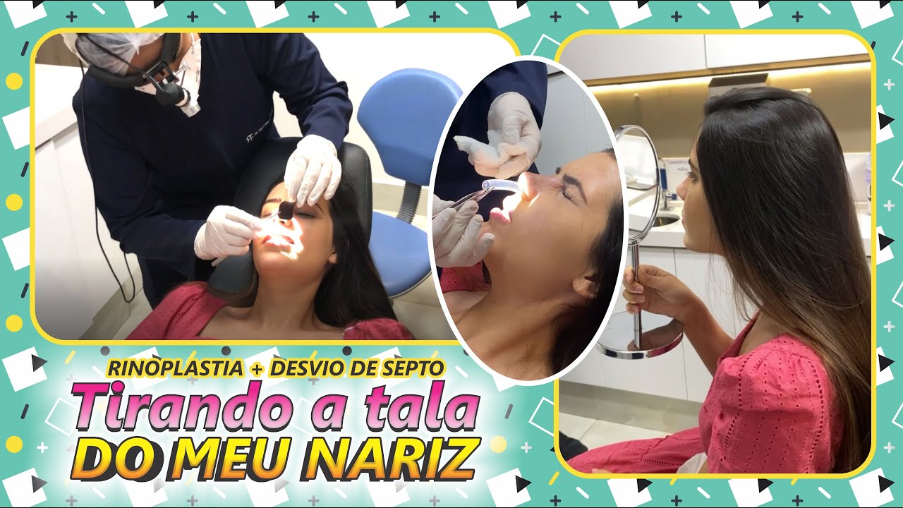 RINOPLASTIA - TIRANDO A TALA DO MEU NARIZ