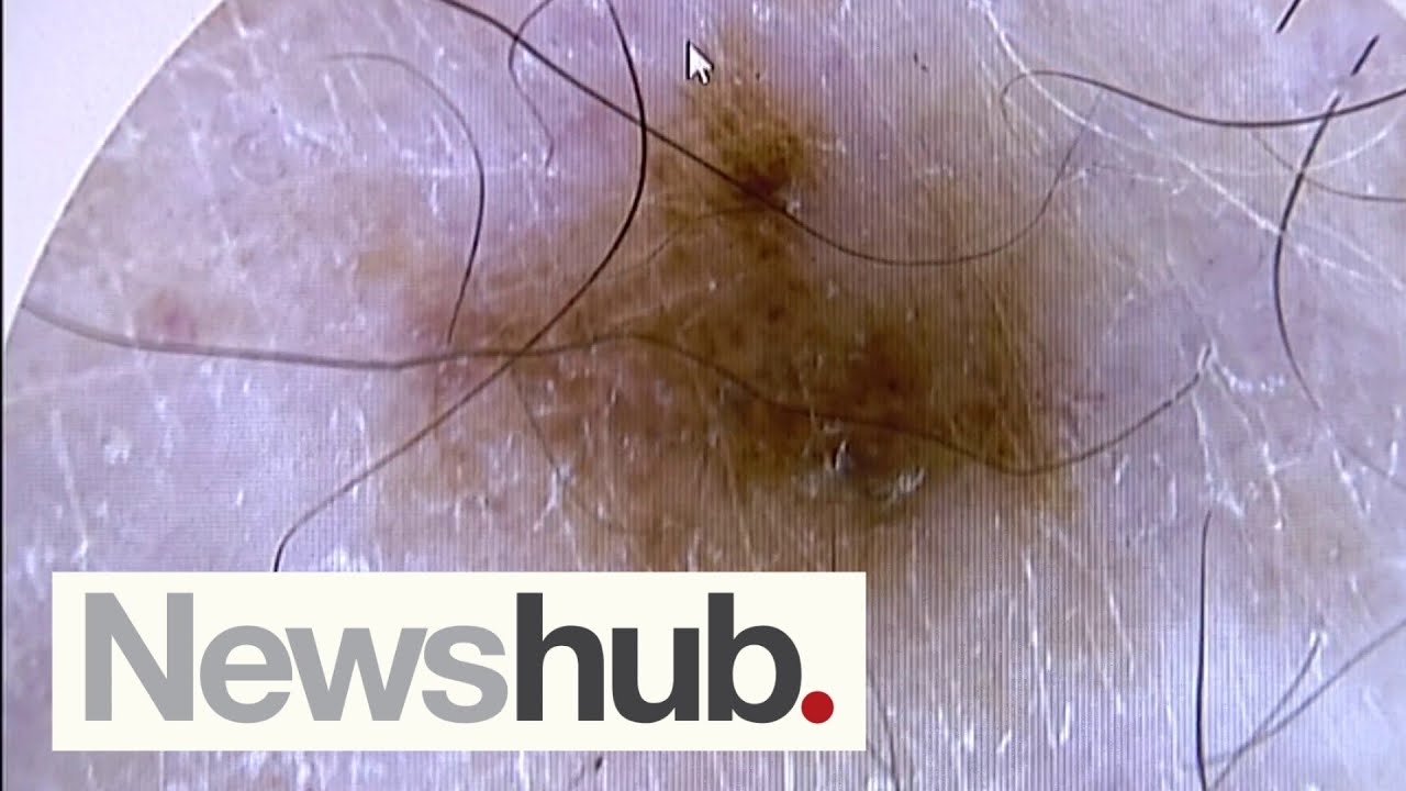 Skin cancer specialist urges Govt to fund melanoma checks for high-risk Kiwis | Newshub