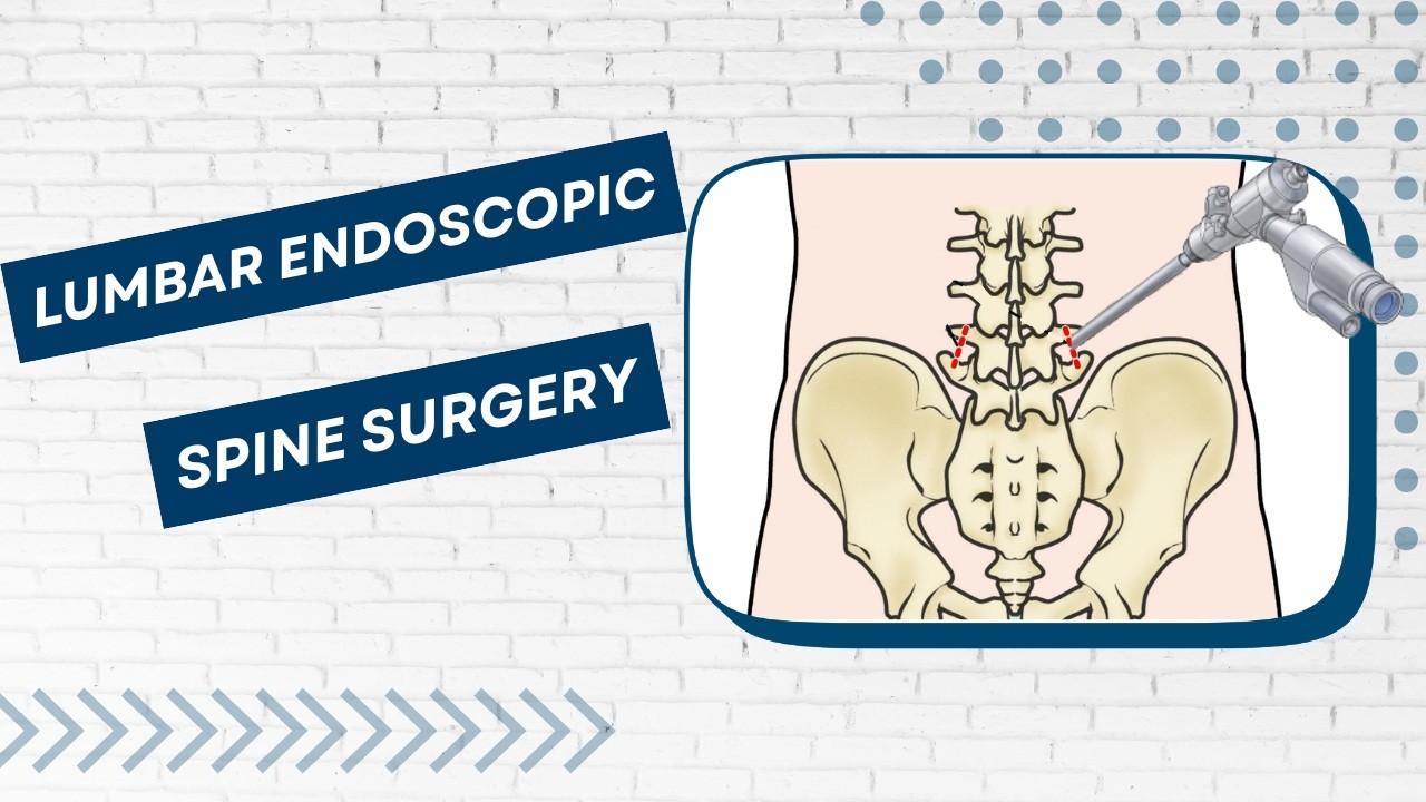 What Is Lumbar Endoscopic Spine Surgery? | Lower Back Surgery Explained