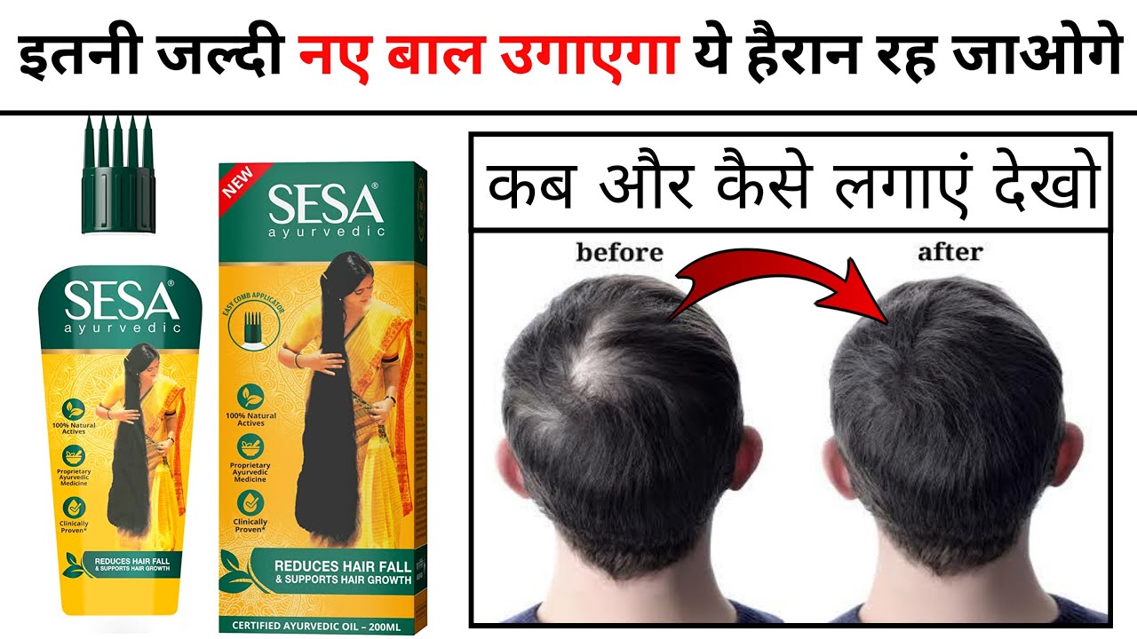 Sesa Hair Oil Review | sesa hair oil results | how to use sesa hair oil