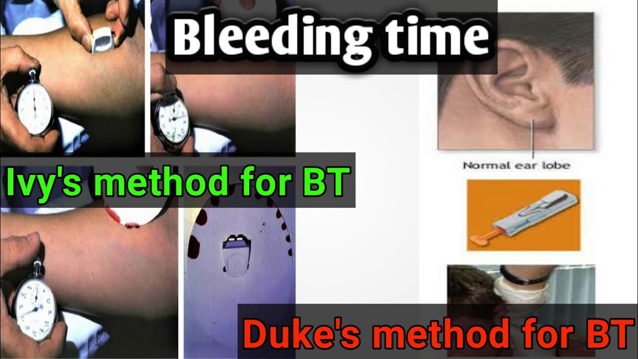 blood Bleeding time test: Duke's and Ivy’s method: blood coagulation profile lecture 2