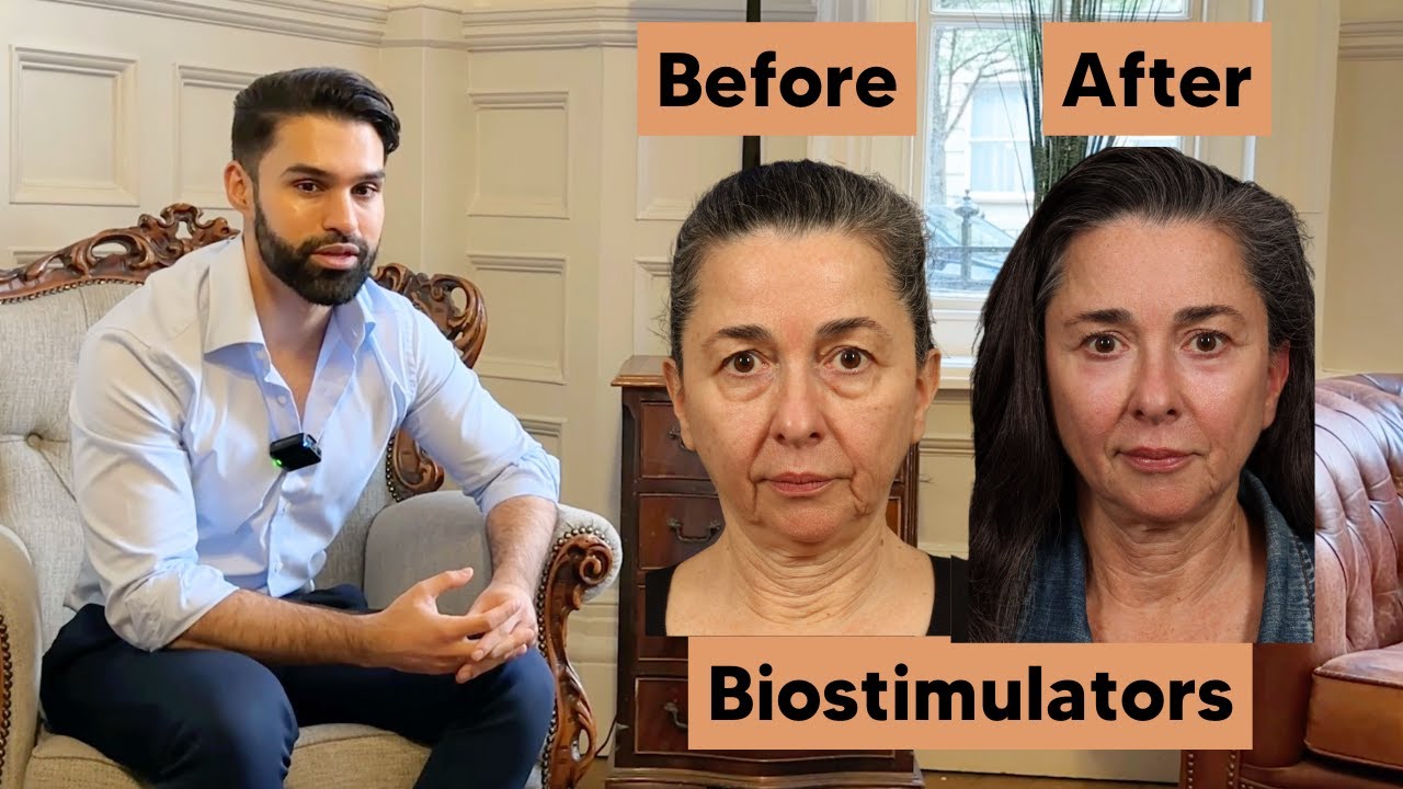 Biostimulators Work Wonders for the Face and Body (Transformation)