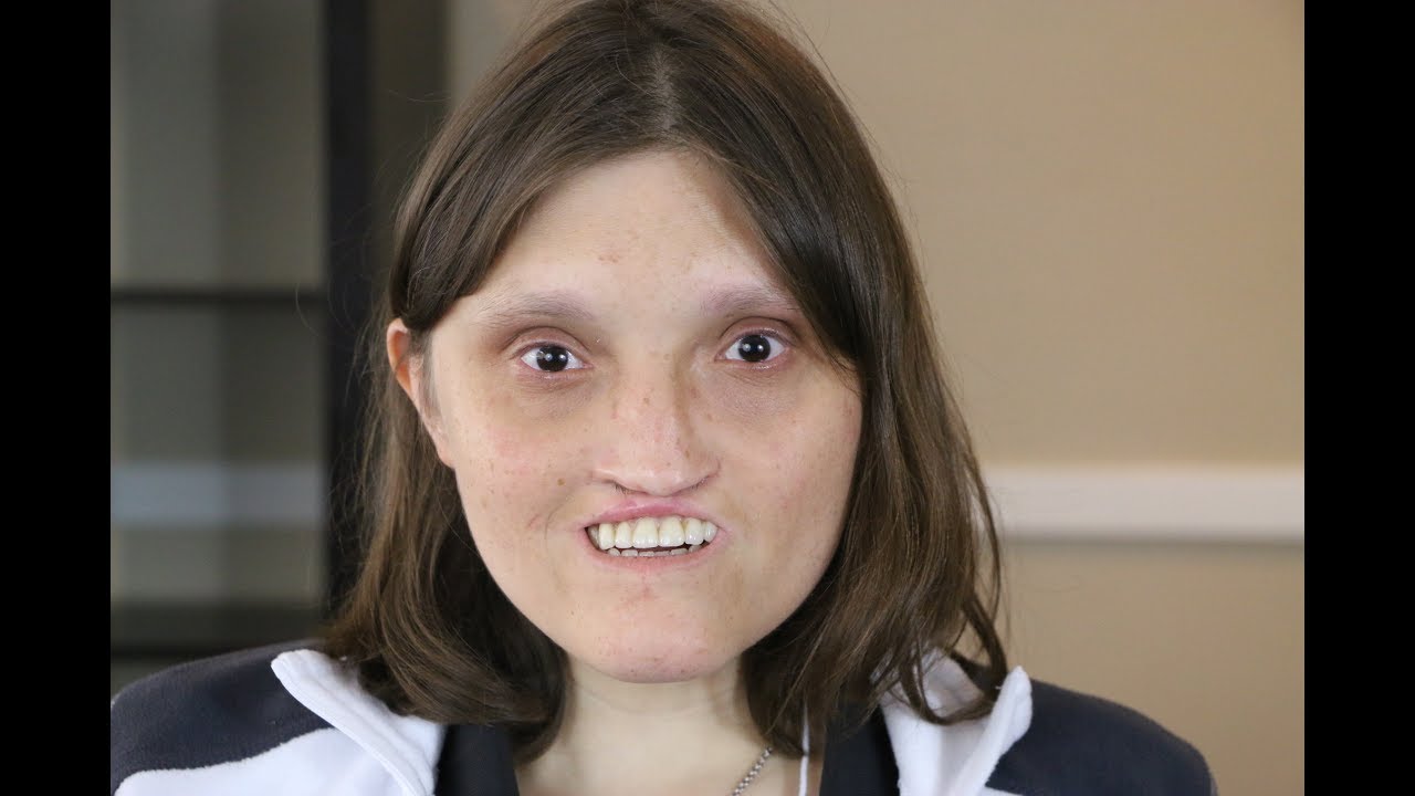 Liz's Humanity (Chromosome 18 Deletion)