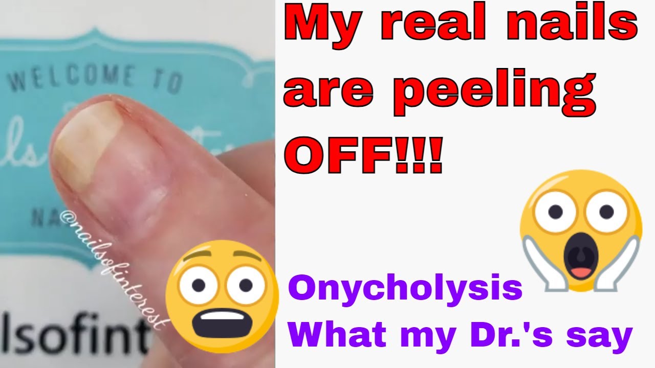 Мои ногти отваливаются!! 😱😱😱 Онихолизис. Что мне сказал врач.