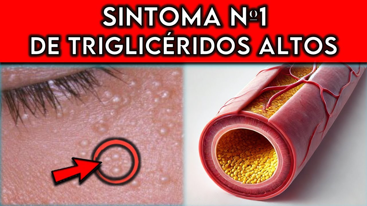 ESTOS son los 7 PRIMEROS S&Iacute;NTOMAS de TRIGLIC&Eacute;RIDOS ALTOS || &iexcl;NO IGNORES estos S&Iacute;NTOMAS!