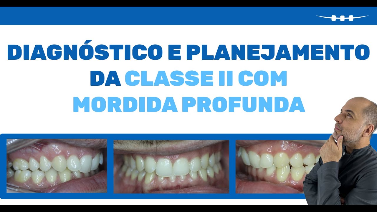Diagnóstico e planejamento da Classe II com mordida profunda