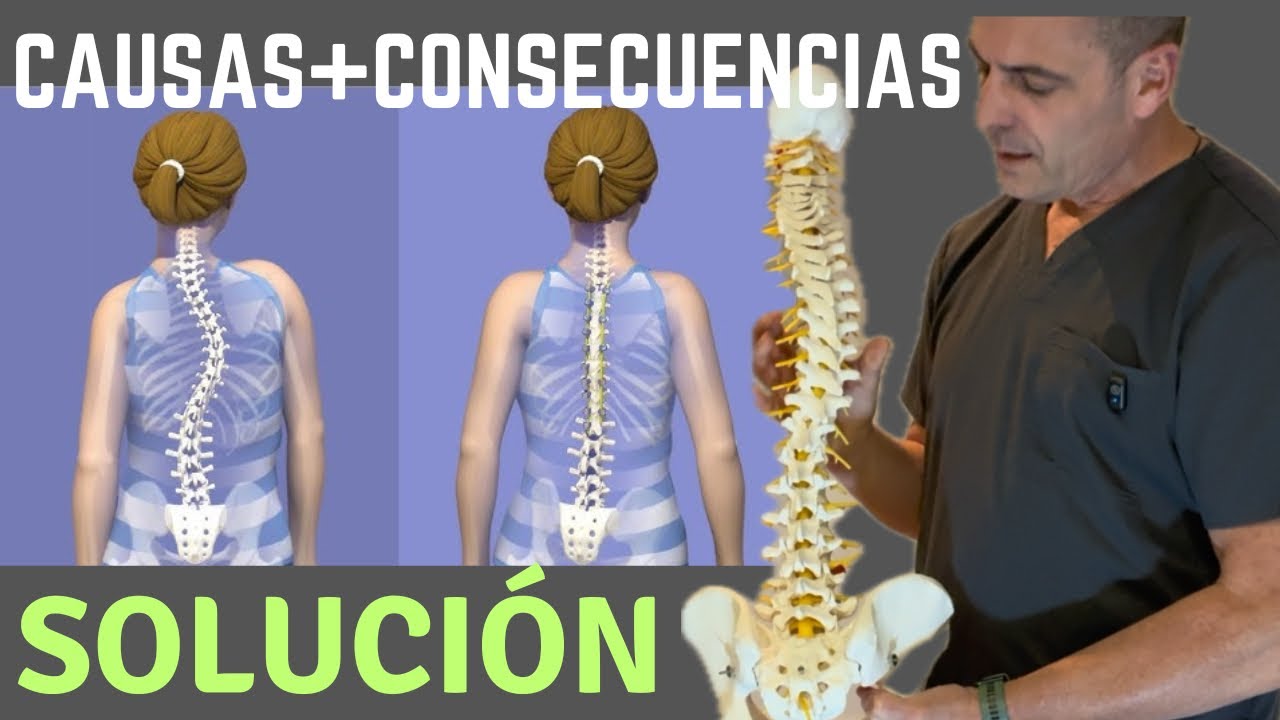 Tienes ESCOLIOSIS? Te explico  que te lo PROVOCA y la SOLUCIÓN #escoliosis #ejercicioencasa 