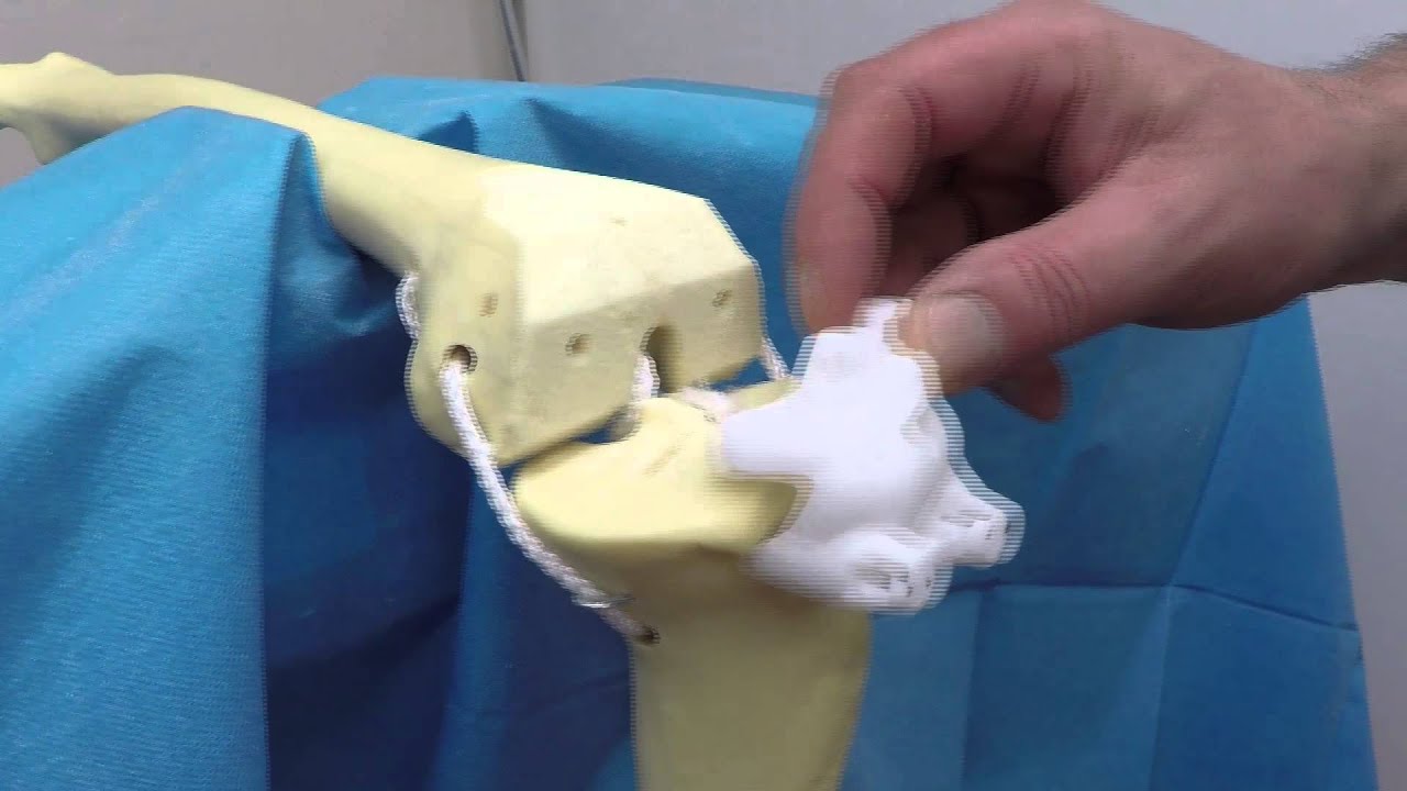 nieuwe knie nieuwe methode