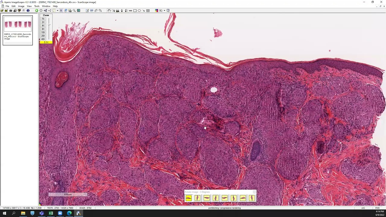 Sarcoidosis