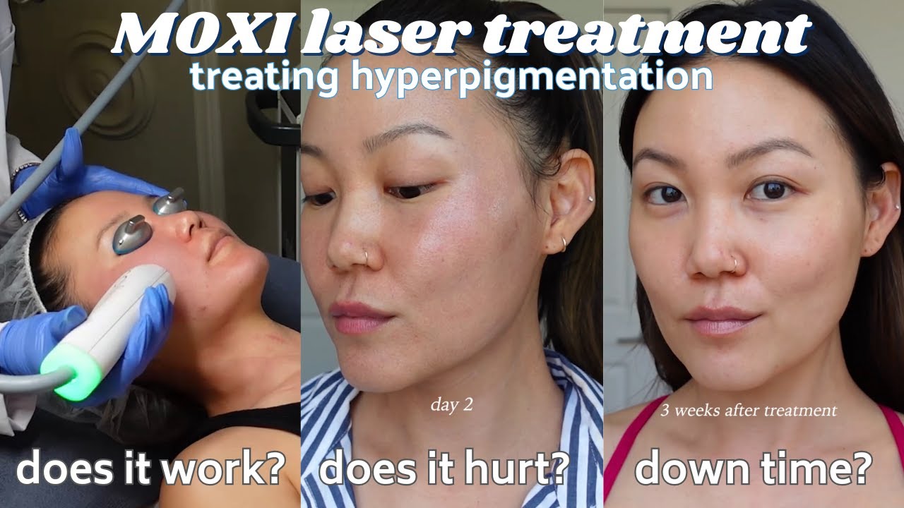 IS IT WORTH IT? MOXI Laser Treatment for hyperpigmentation, skin texture, collagen production
