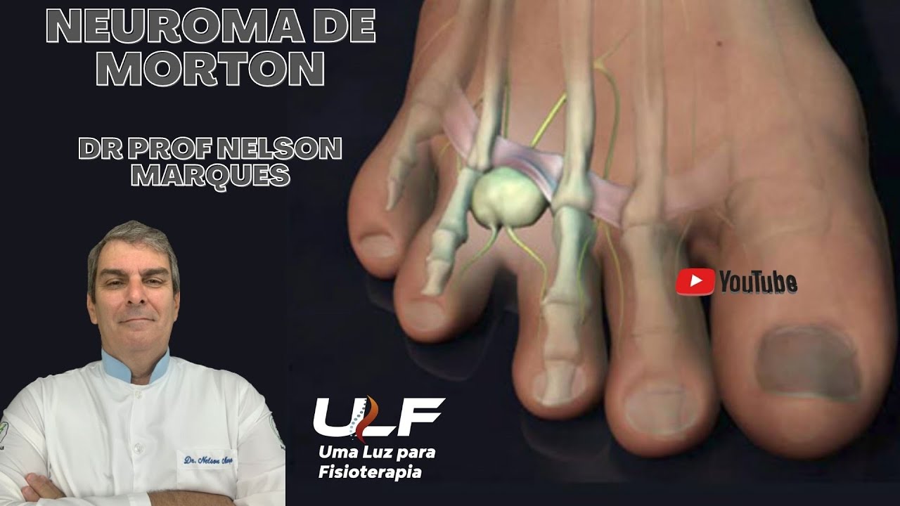 NEUROMA DE MORTON - Dr. Prof. Nelson Marques