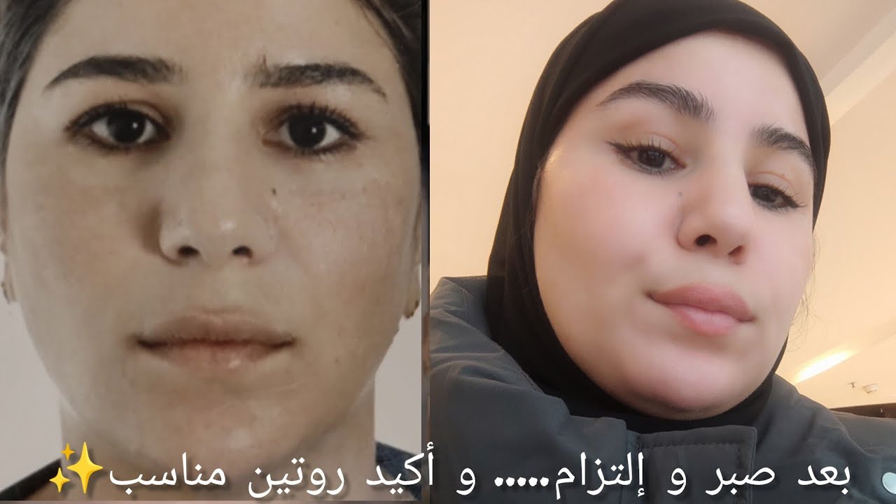 كيفاش تخلصت من الكلف بدون مبالغة...رجّعت بشرتي و ثقتي بنفسي!  عطيتك الخاصة👌