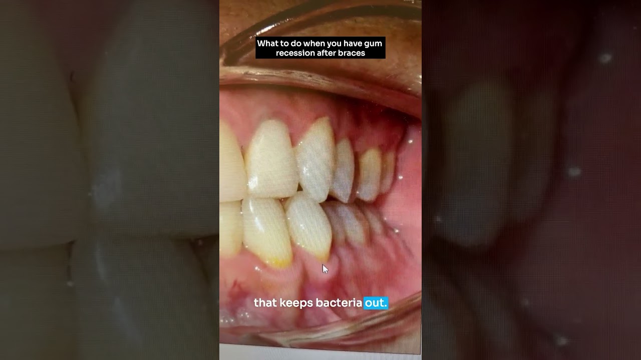 Did your braces damage your gums? #shorts
