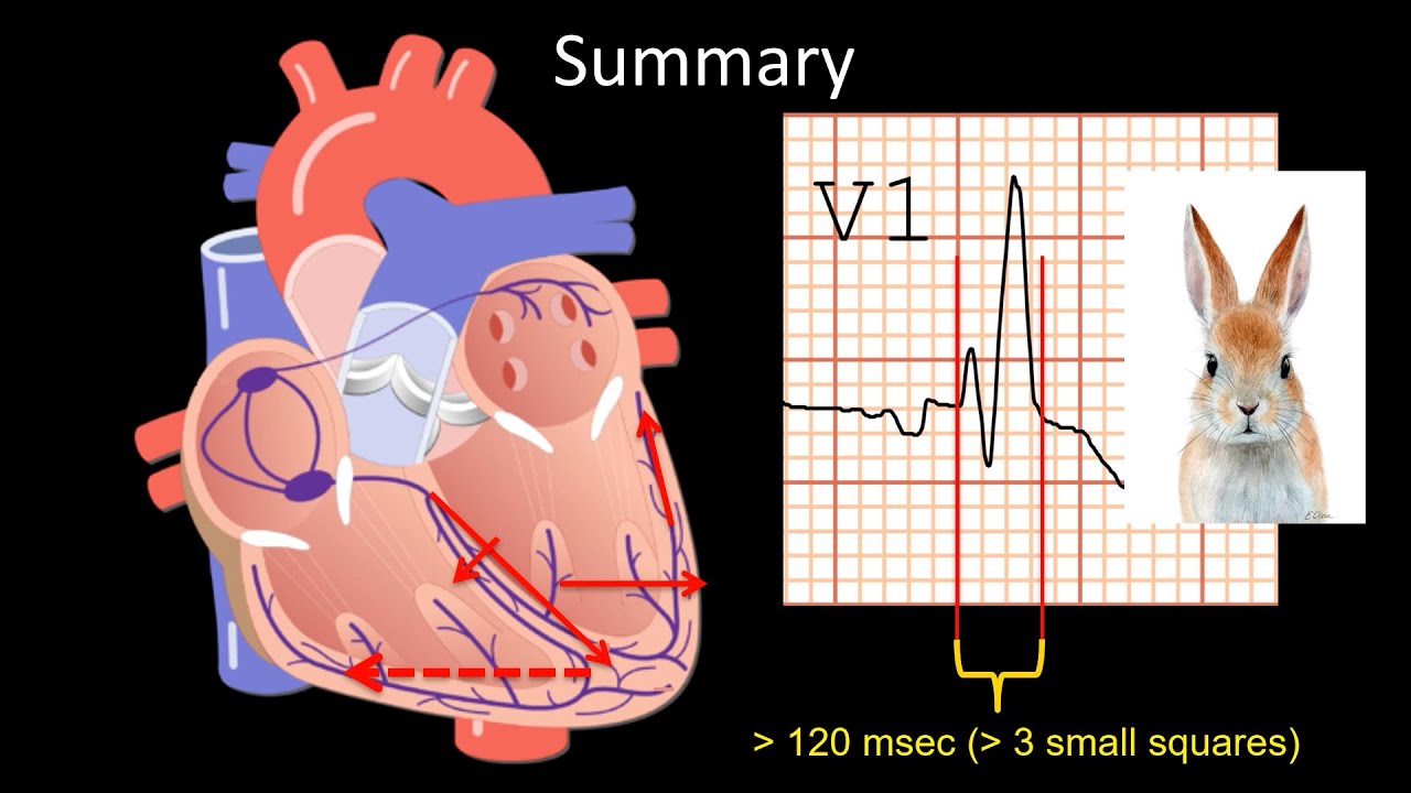 How to Read an ECG: Right Bundle Branch Block (RBBB)