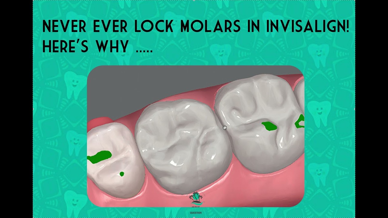 Do NOT Lock MOLARS in Invisalign- Here's why.....