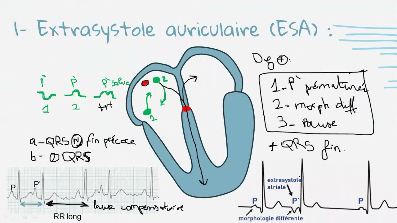 Troubles du rythme - Supra Ventriculaires