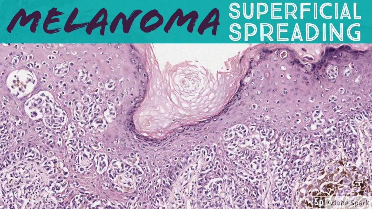 Superficial Spreading Melanoma: 5-Minute Pathology Pearls