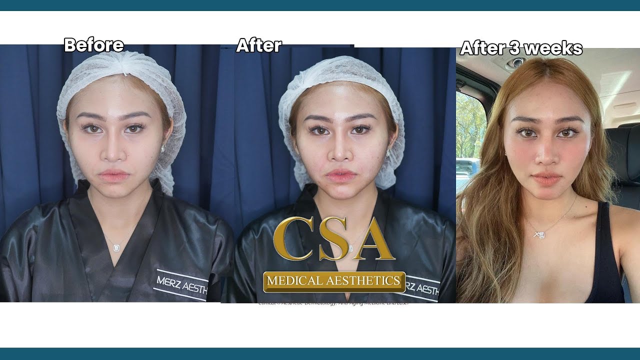 Achieving Perfect V Contour