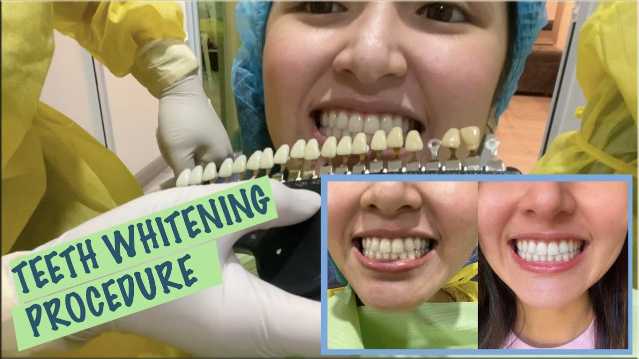EFFECTIVE TEETH WHITENING l APPLE DAVID