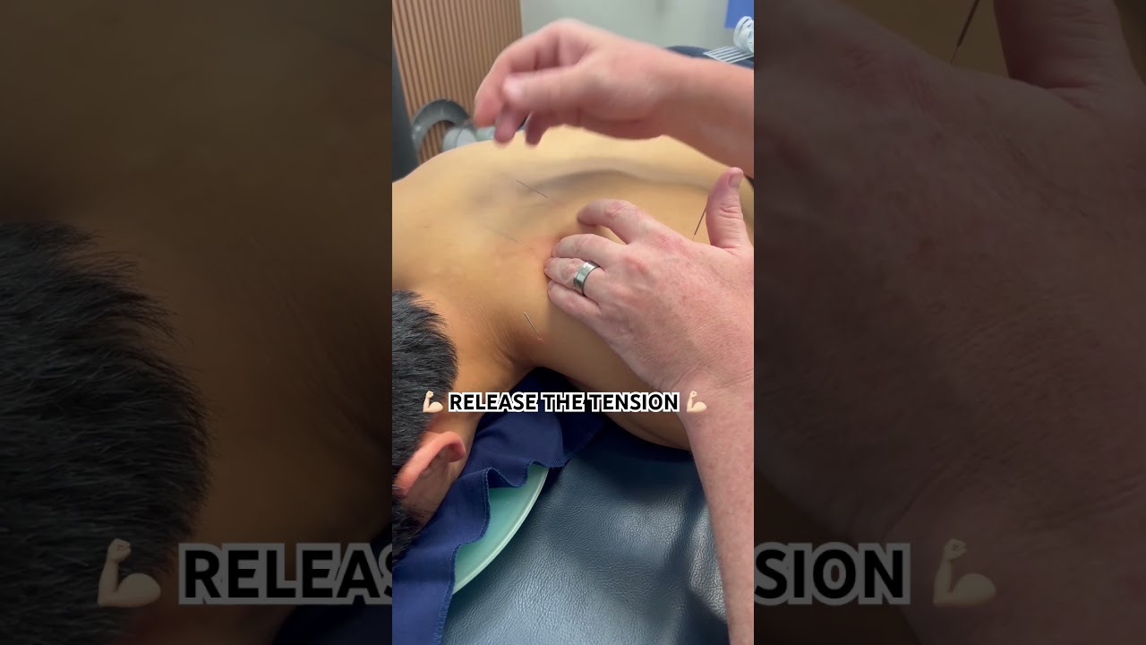 Release muscle tension with dry needling #chiro #chiropratic