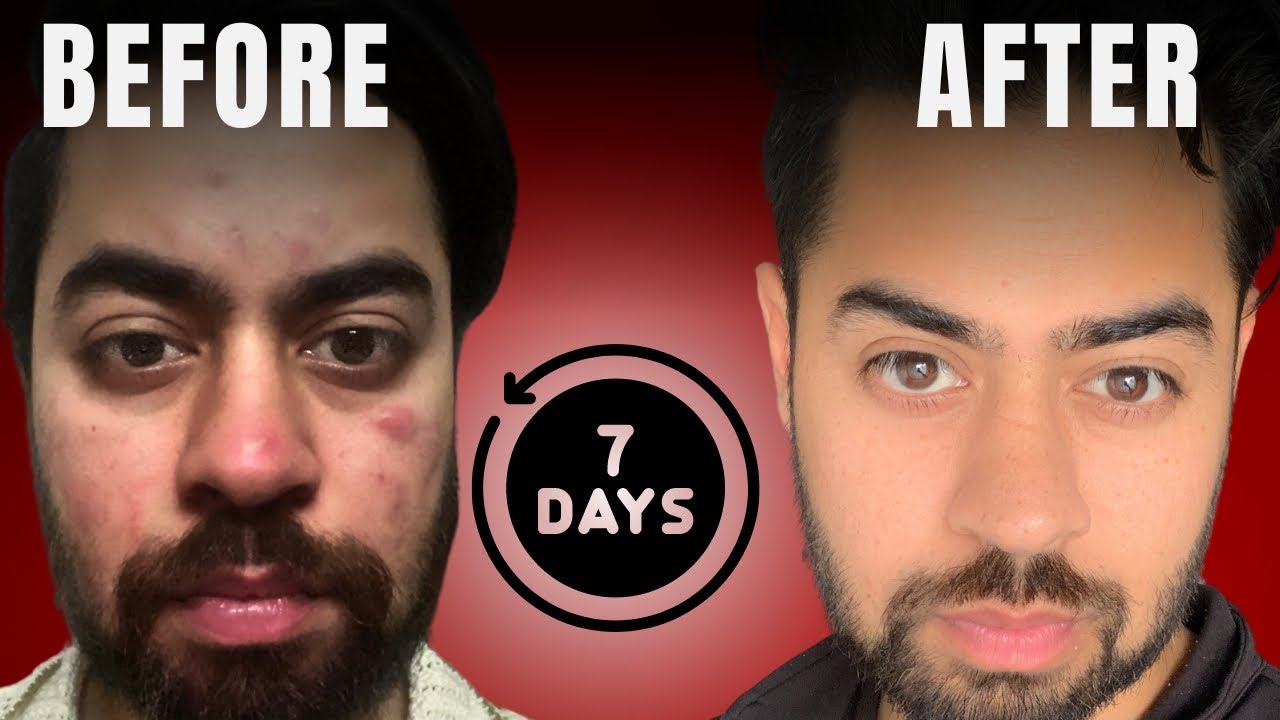 Pimples hatane ka sabse tez tareeka | Remove acne in 7 days