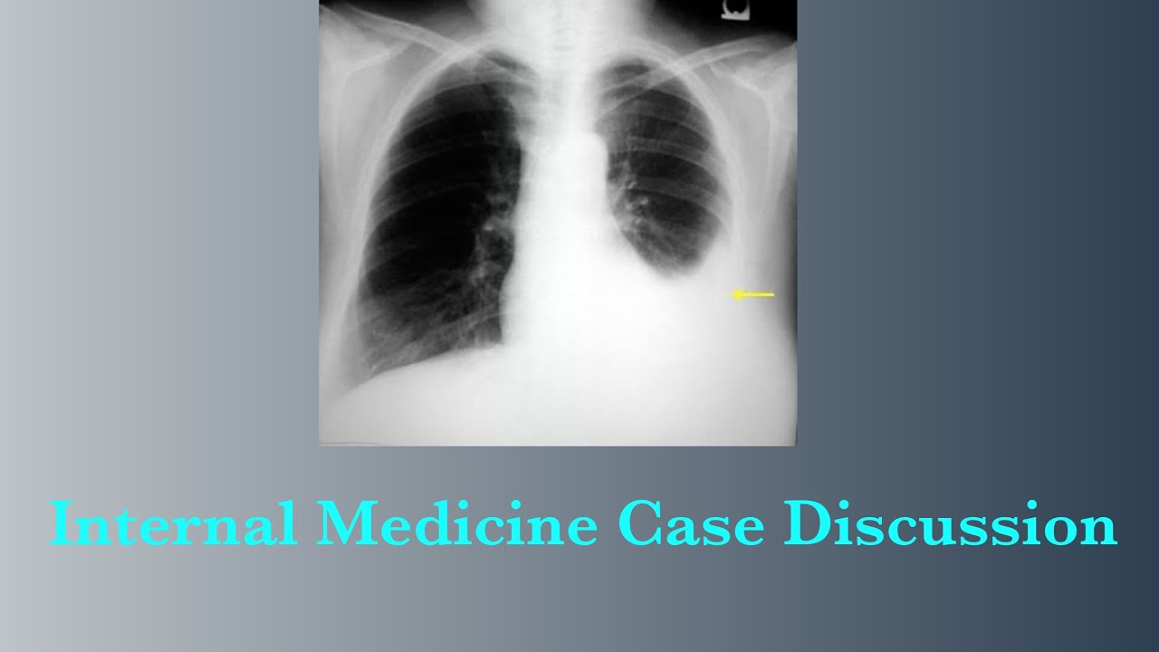 Internal Medicine Case Discussion || Pleural Effusion