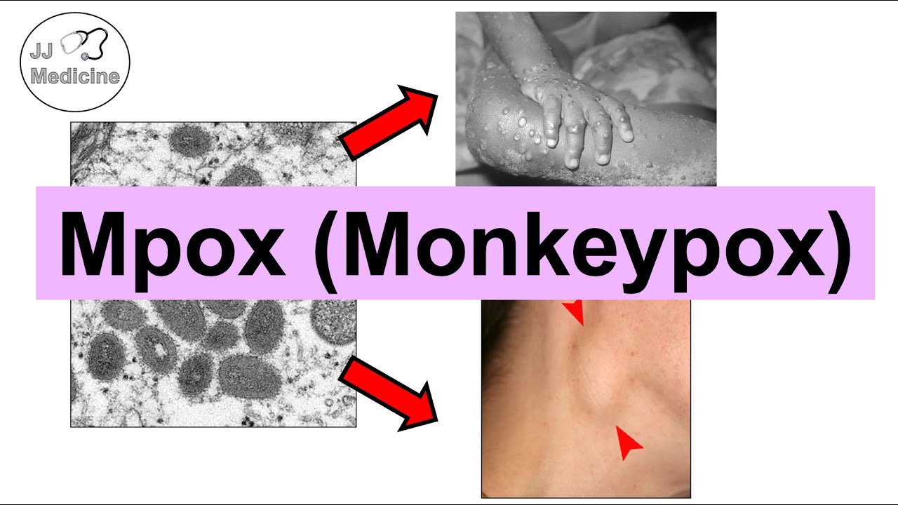 Mpox (Monkeypox) | Transmission, Pathophysiology, Signs & Symptoms, Diagnosis, Treatment