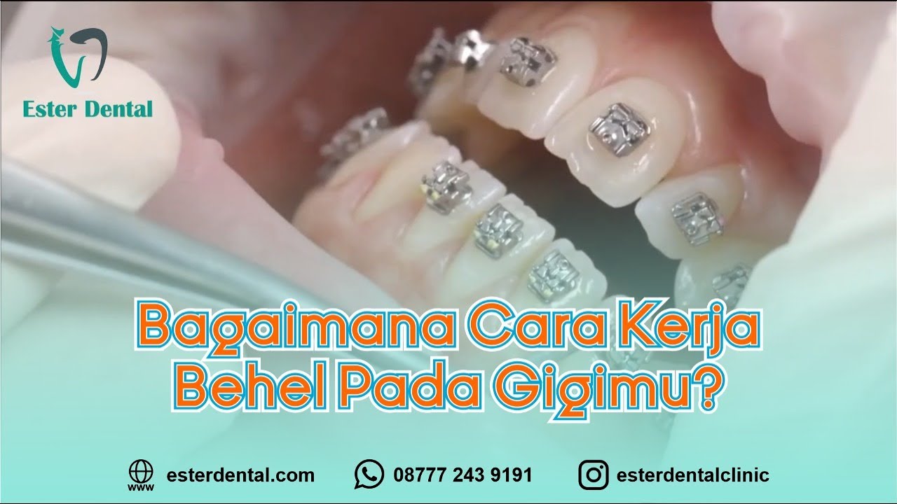 Cara Kerja Behel Pada Gigimu Yang Harus Kamu Tahu