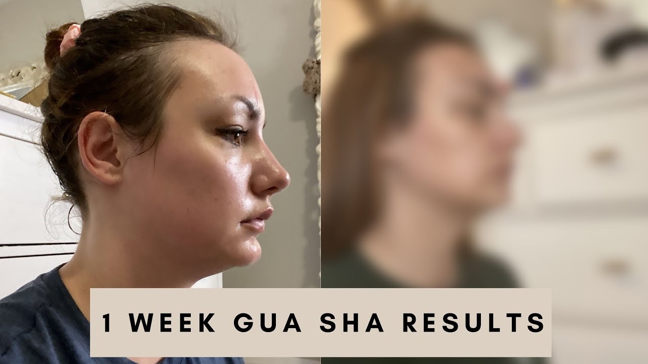1 Week Gua Sha Results - Before and After